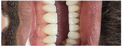 Imagem 6 da empresa ODONTOCOMPANY PESTANA | DENTISTA, IMPLANTE DENTÁRIO, PRÓTESE DENTÁRIA, PRÓTESE PROTOCOLO, CLAREAMENTO, FACETAS, BOTOX Clínicas Odontológicas em Osasco SP